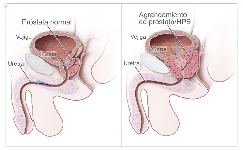 La Hipertrofia Benigna de Próstata (HBP) está causada por alteraciones de tamaño en la próstata debido a cambios hormonales propios del paso de los años. El Dr. López informa