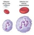 La anemia megaloblástica provoca una disminución de glóbulos rojos, aunque estos tienen gran tamaño. El Dr. Alcaraz, hematólogo, informa