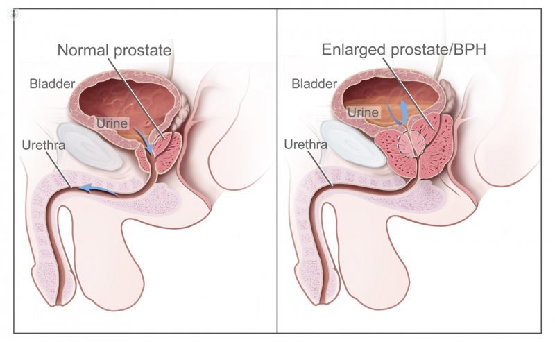 hiperplasia benigna prostata