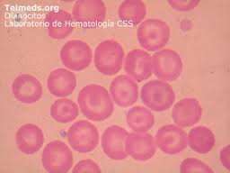 La Talasemia es un tipo de anemia que provoca una disminución de los niveles de hemoglobina. El Dr. Alcaraz te informa 