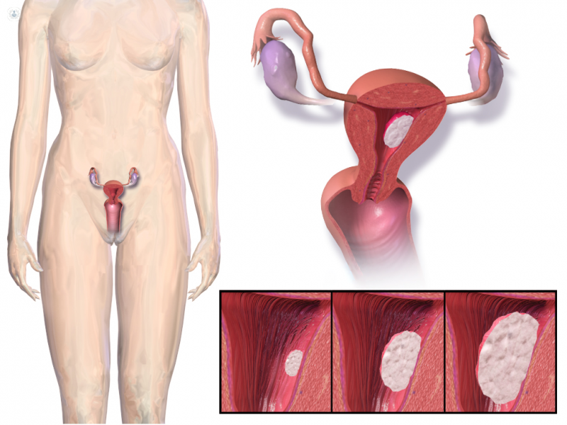 El cáncer de útero es el que tiene más prevalencia en mujeres mayores de 60 años, siendo el tumor más frecuente en órganos genitales femeninos. 