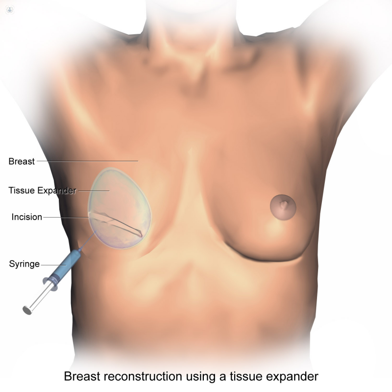 procedura di ricostruzione del seno dopo il tumore al seno