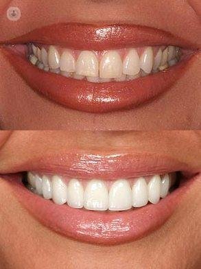 Las carillas dentales son láminas de poco grosor que aumentan el volumen de los dientes para que luzcan mejor.