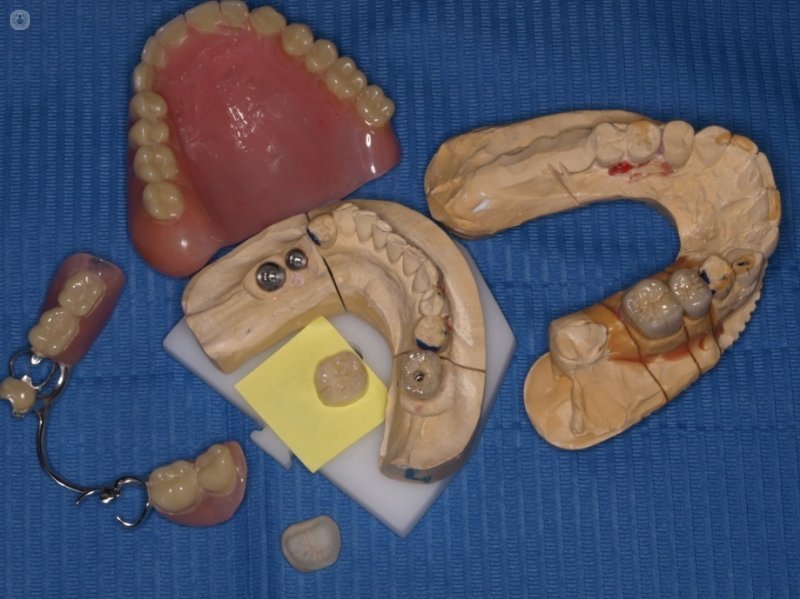 ¿En qué consiste la aplicación de las prótesis dentales fijas? Conoce todos los detalles gracias a este artículo.