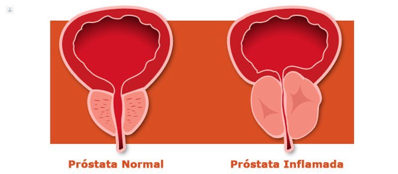 Hiperplasia benigna de próstata cirugía láser