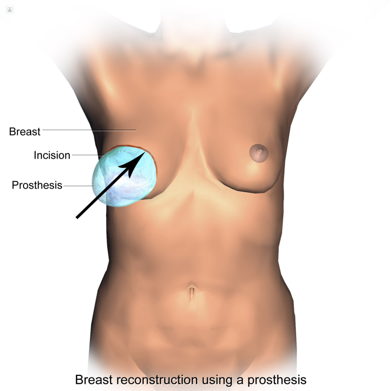 Reconstruccion mamaria mediante protesis