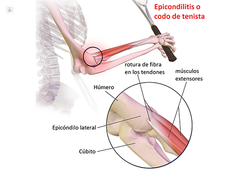 La epicondilitis o codo de tenista es una lesión que provoca dolor en la parte externa del codo