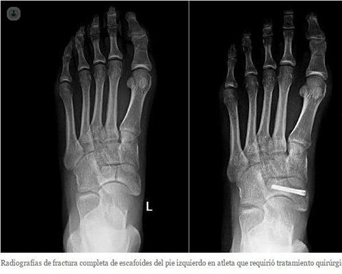 foot fracture stress