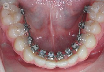 ortodonzia linguale è una delle più richieste negli adulti