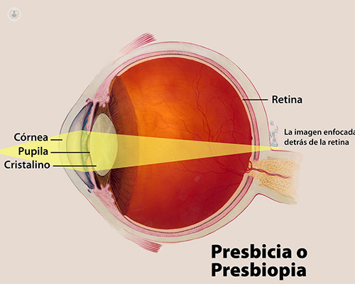presbyopia