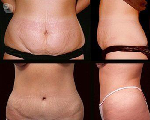 antes y despues abdominoplastia