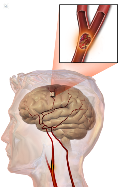 Infografía donde se muestra cómo se produce un ictus en el cerebro - by Top Doctors