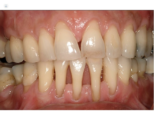 Primer plano de unos dientes con periodontitis - by Top Doctors