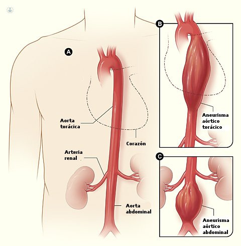 Gráfico o infografía con la explicación de cómo se produce un aneurisma - by Top Doctors