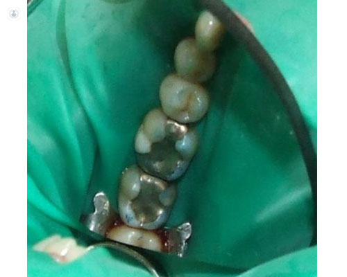 Boca de un paciente con amalgama dental - Top Doctors