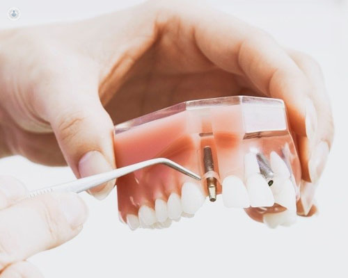 El injerto de hueso dental permite realizar implantes dentales en pacientes con poca base de hueso - Top Doctors
