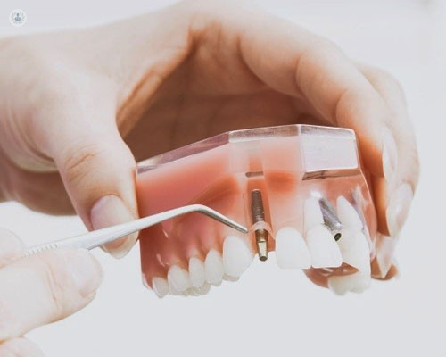 Primer plano de la maqueta de una dentadura, mostrando implantes dentales - implantes dentales - by Top Doctors