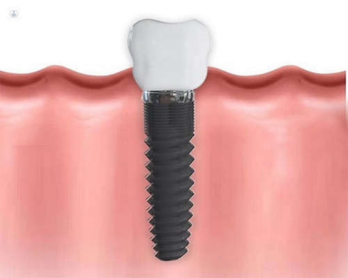 Materiales para pilares dentales | Top Doctors
