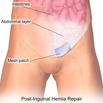Hernia inguinal por laparoscopia - Top Doctors Blog