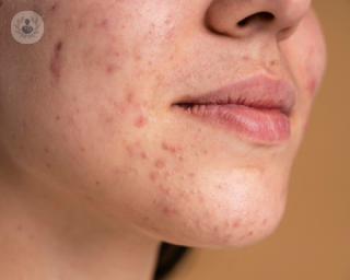 acne dermocosmetica productos tratamientos