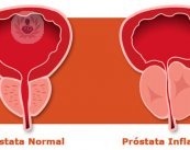 Hiperplasia benigna de próstata cirugía láser