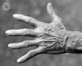 las artritis todo lo que se necesita saber