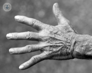 artritis enfermetats reumàtiques