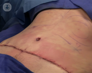 Cirugía para acabar con el exceso de grasa del abdomen