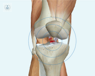 Lesión del ligamento lateral interno | Top Doctors