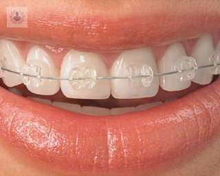 diferencias entre la ortodoncia convencional y la invisible