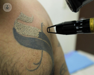 Eliminar tatuajes con láser: qué es, síntomas y tratamiento | Top Doctors