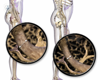 ejemplo de osteoporosis