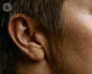 La otoplastia como solución a las deformidades auriculares.