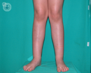 Corrección genu valgo (piernas en x): qué es, síntomas y tratamiento | Top  Doctors