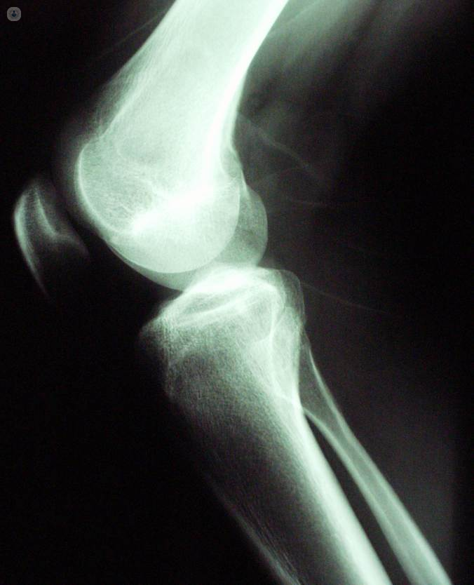 Artrosis de rodilla: causas, tratamiento y prevención | Top Doctors