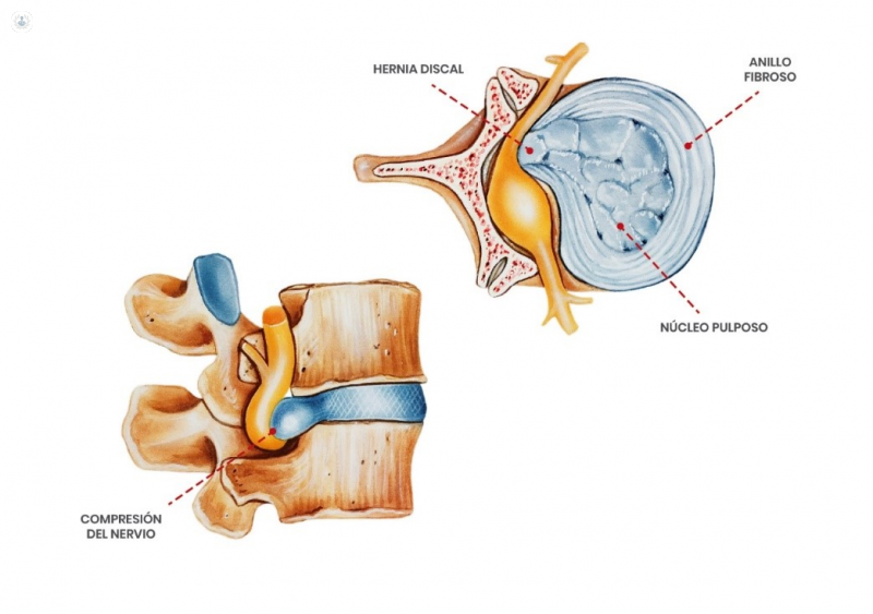 Qué síntomas presenta una hernia discal de la zona lumbar?