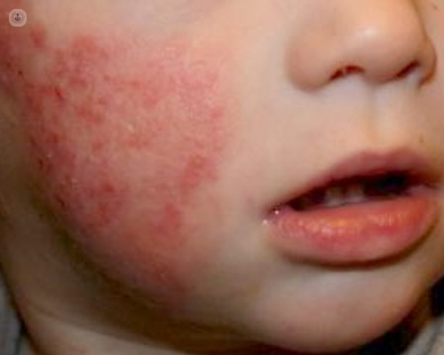 Dermatitis atópica en niños | Top Doctors