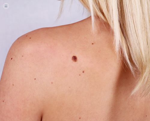 El melanoma, la primera causa de muerte dermatológica | Top Doctors