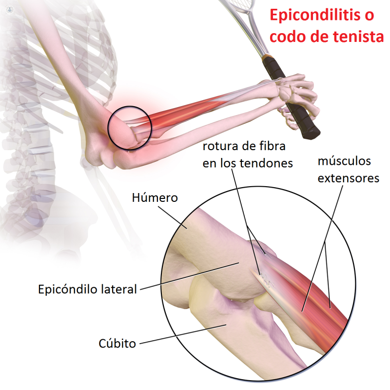 Consumirse Objetor Escribir Una Carta Epicondilitis Anatomia Estribillo