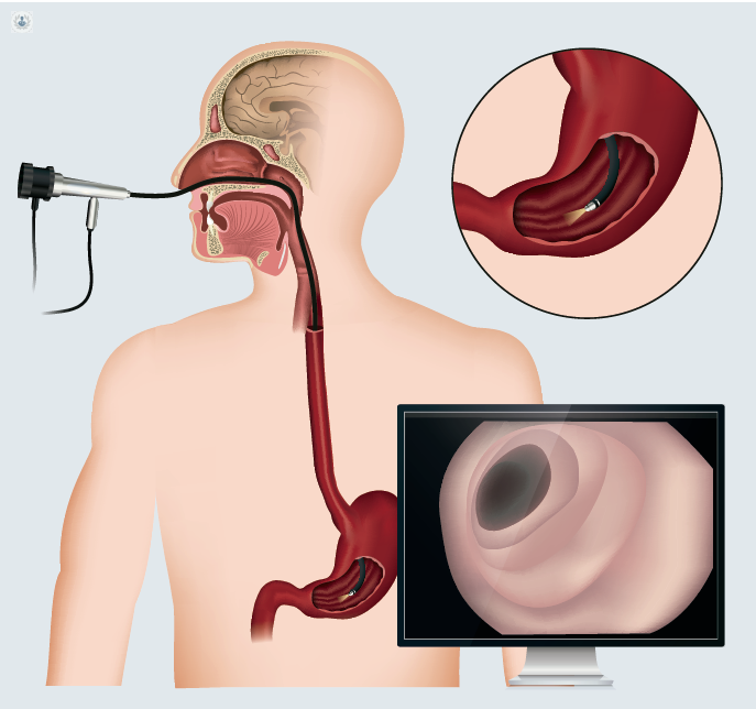 Gastroscopia: qué es, síntomas y tratamiento | Top Doctors