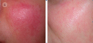 Antes y después de un tratamiento láser de rosácea