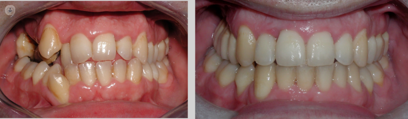 Ortodoncia estetica: tipologias y beneficios
