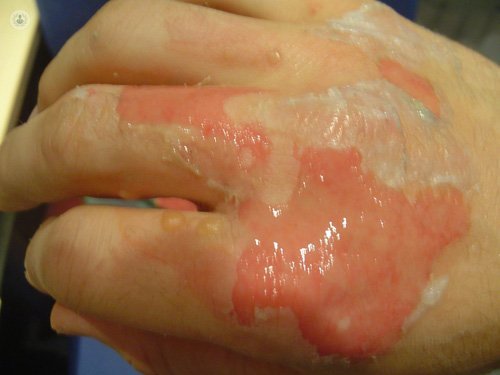 Técnicas de reconstrucción de la piel tras una quemadura