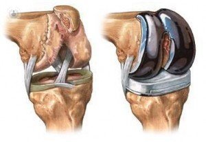 Prótesis de rodilla, recupera la movilidad y alivia el dolor