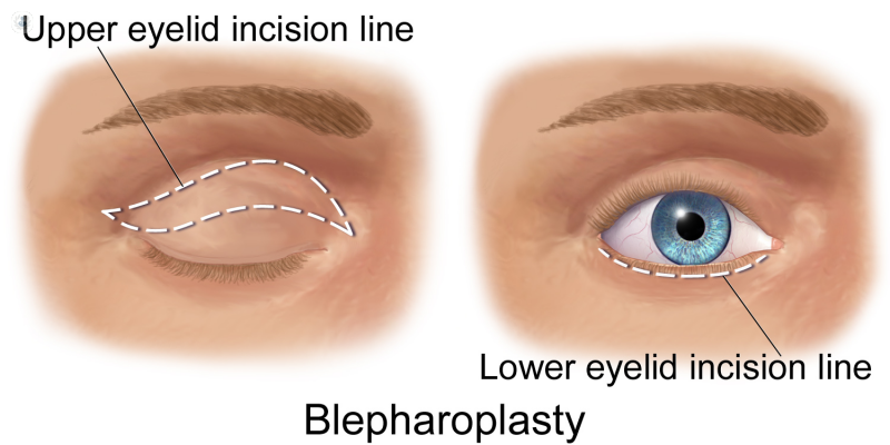 Rejuvenecimiento de la mirada con blefaroplastia