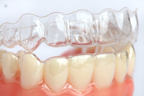 Retenedores dentales tras la ortodoncia invisible