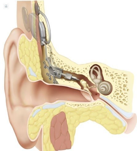 Implantes de oido
