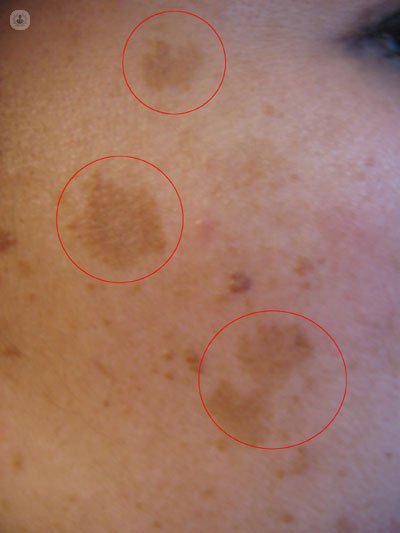 La importancia de revisar las manchas en la piel