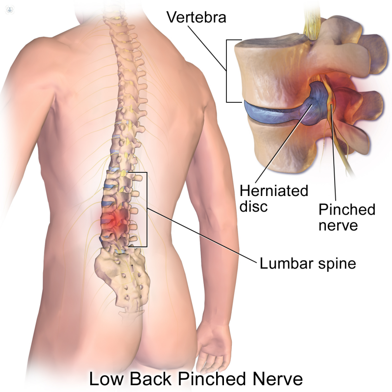 Causas de la hernia discal lumbar