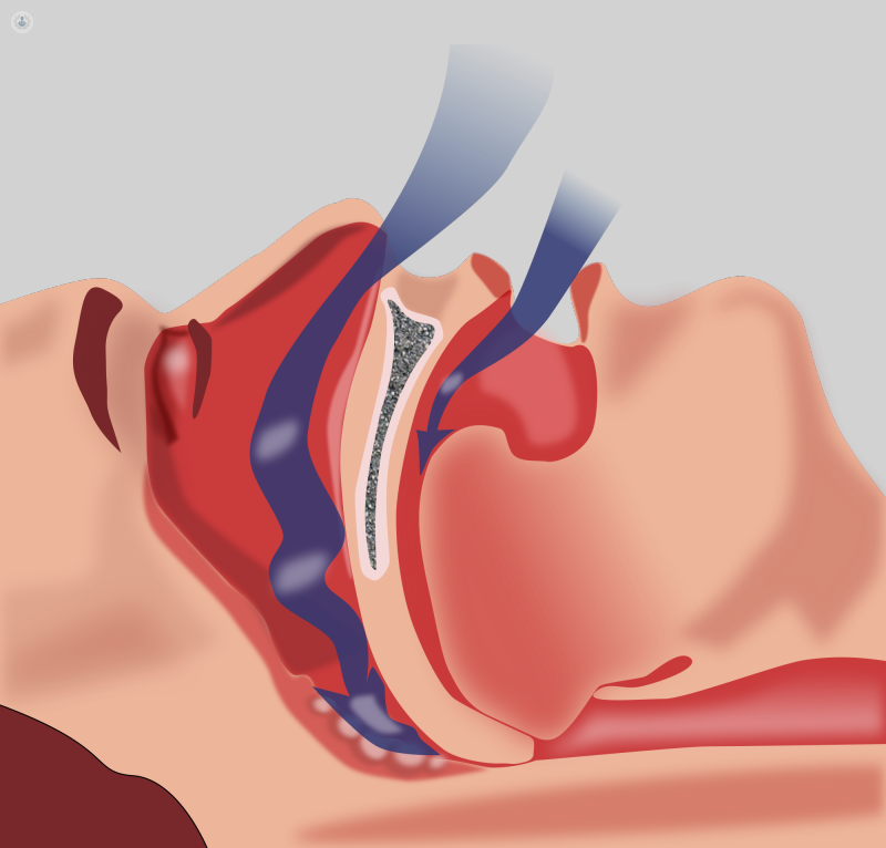 Cirugía maxilofacial: apnea obstructiva del sueño